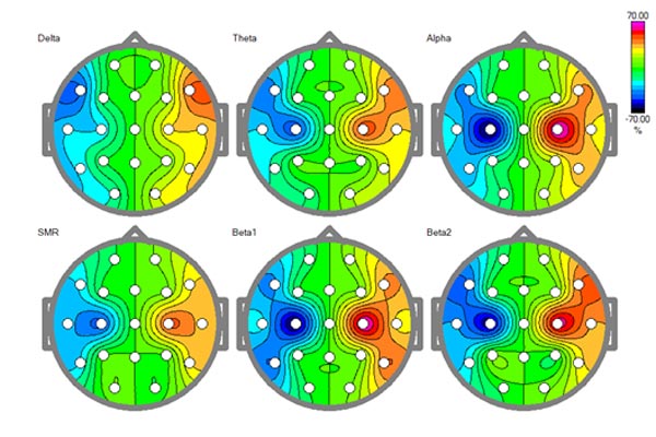 Badanie QEEG (Quantitative Electroencephalography)